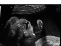Cleft lip midline